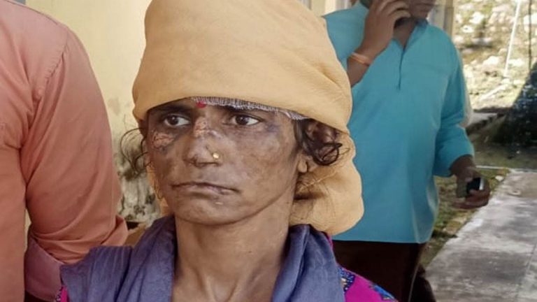 सास और ननद ने क्रूरता से महिला को गर्म तवे से जलाया, विरोध करने पर बच्चों से की मारपीट